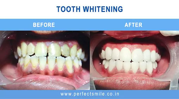 Tooth whitening before and after