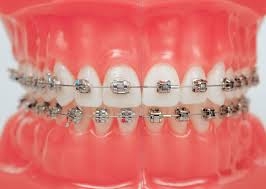 Metallic Braces