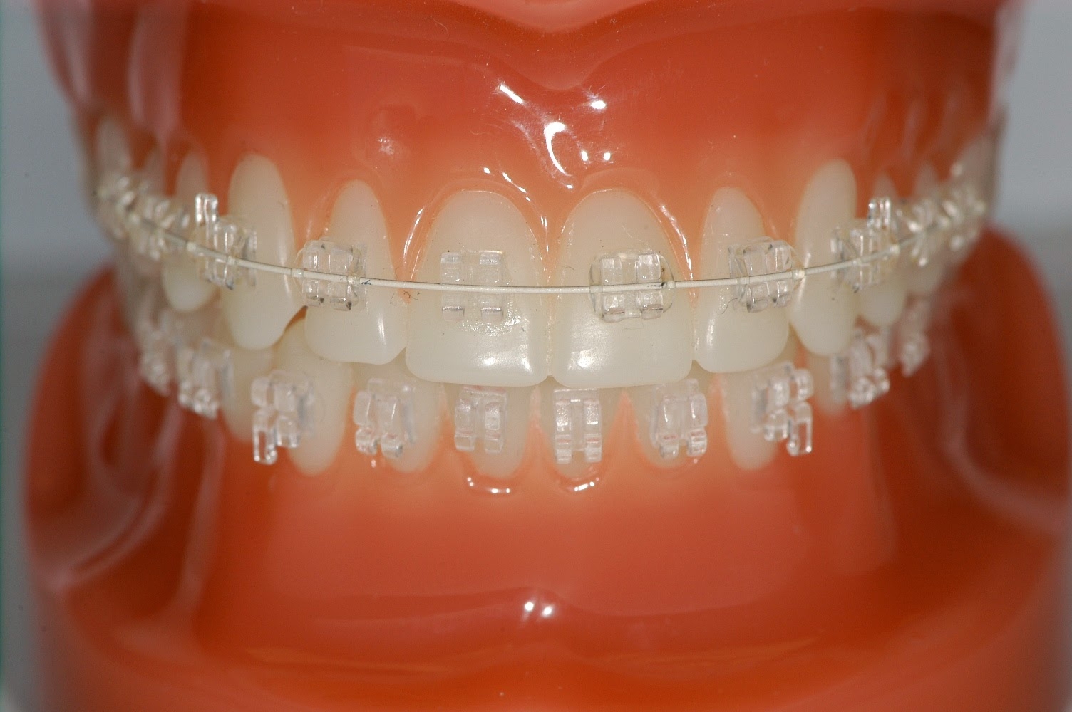 Braces