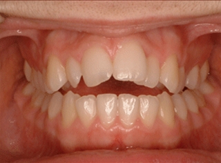 invisible-braces.html
