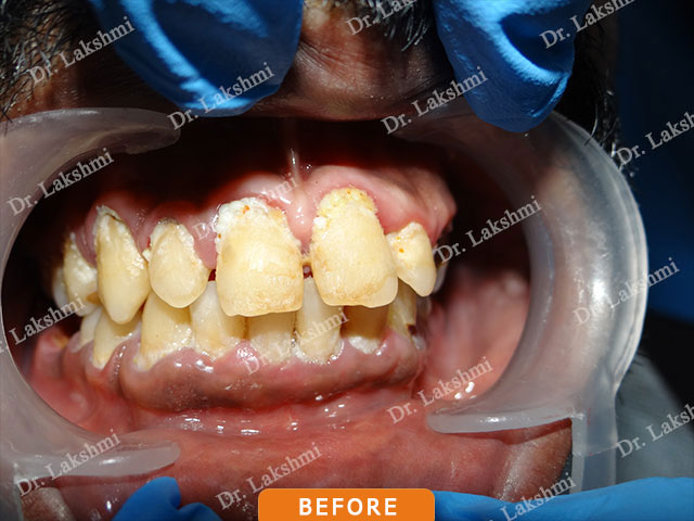 Smile Makeover