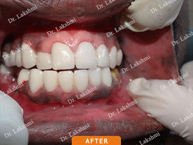 Smile Makeover