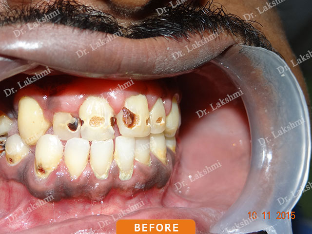 Smile Makeover