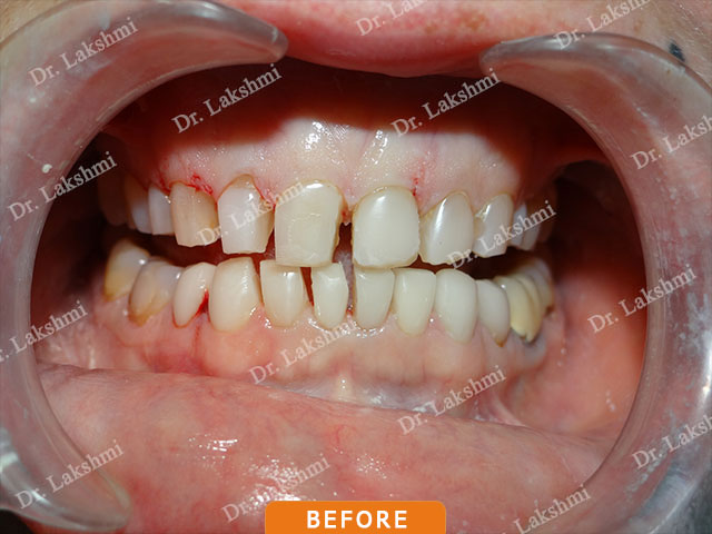 Smile Makeover