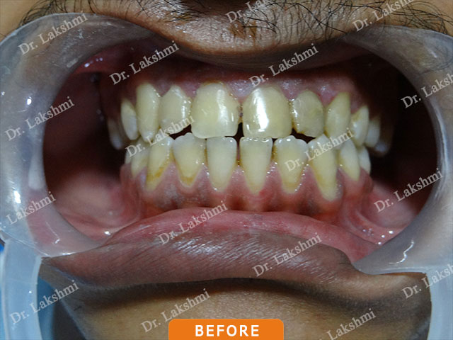 Smile Makeover