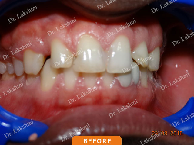 Smile Makeover