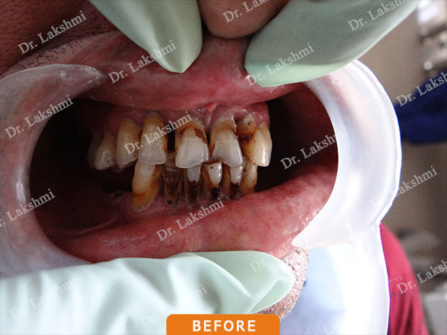 Smile Makeover