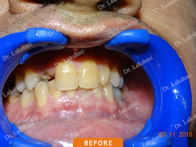 Smile Makeover