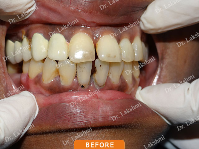 Smile Makeover