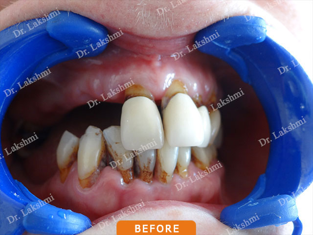 Smile Makeover
