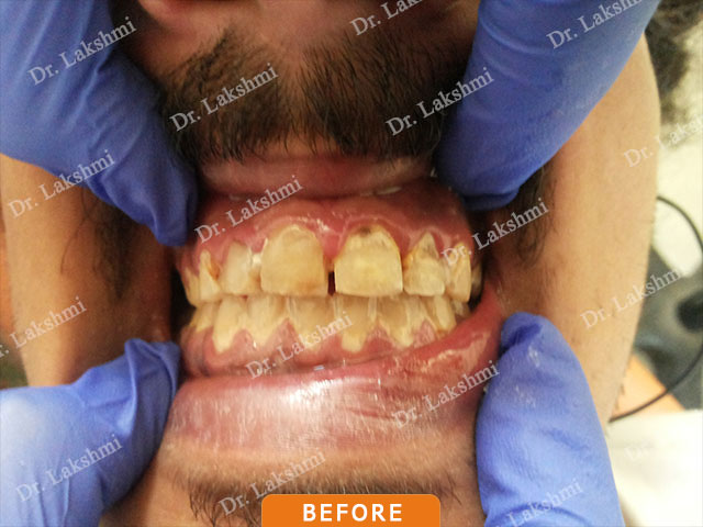 Smile Makeover