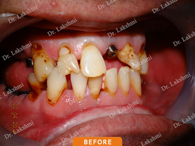 Smile Makeover