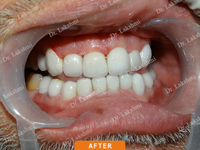 Smile Makeover