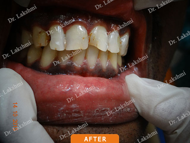 Smile Makeover