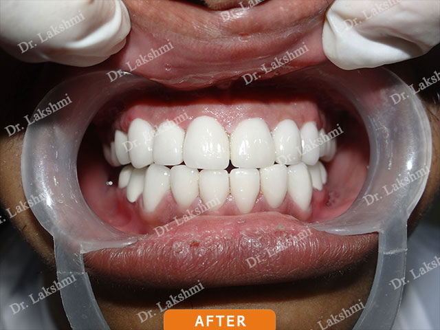 Smile Makeover