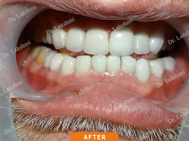 Smile Makeover