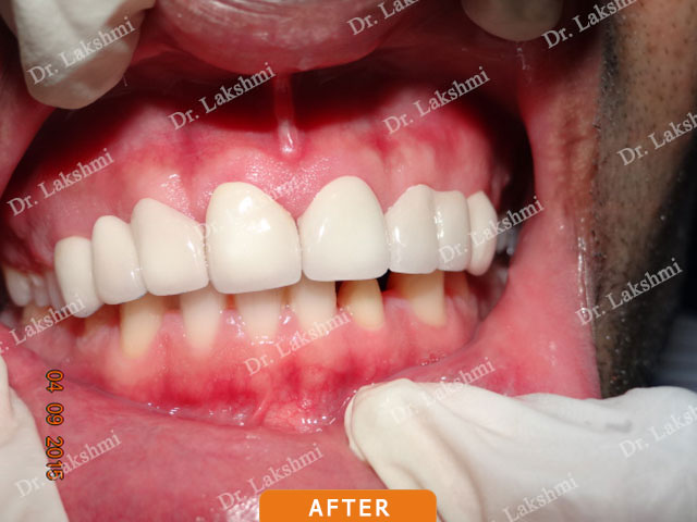 Smile Makeover