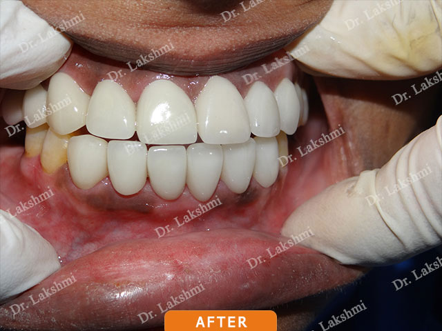 Smile Makeover