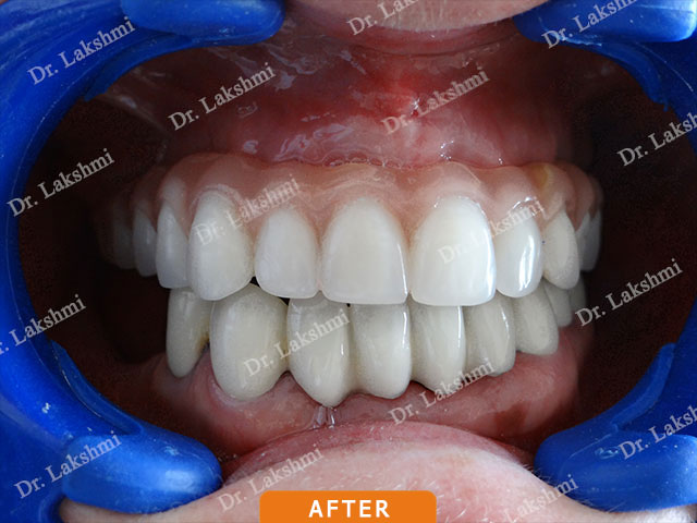 Smile Makeover