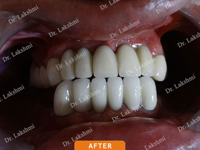 Smile Makeover