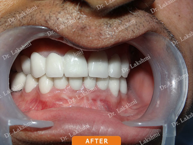 Smile Makeover
