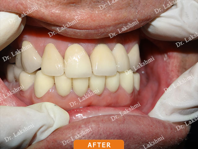 Smile Makeover