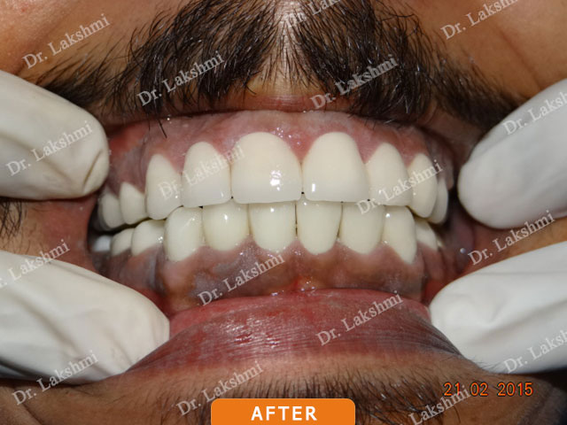 Smile Makeover