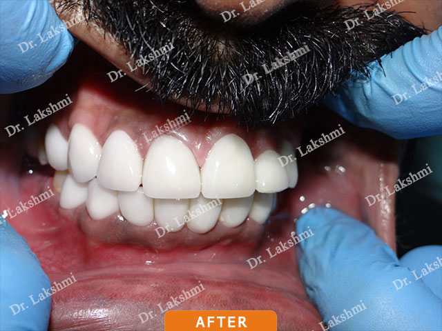 Smile Makeover