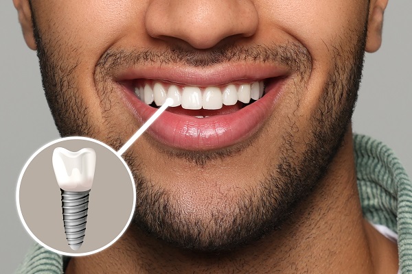 Best Dental Clinic in Bangalore