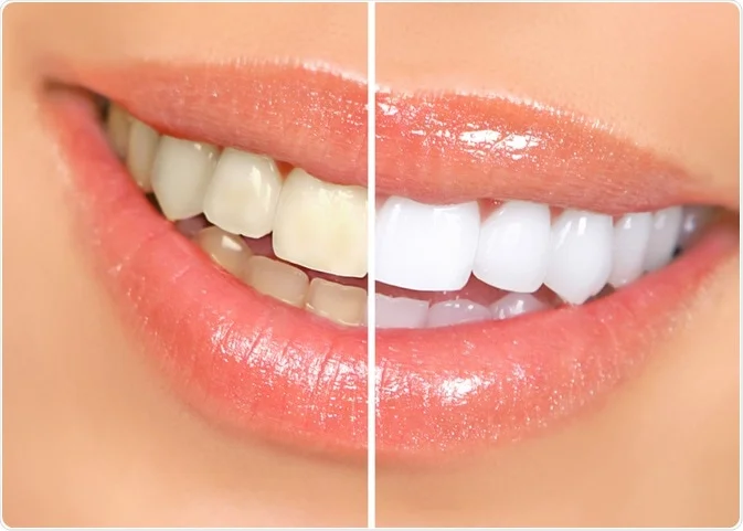 Best Dental Clinic in Bangalore