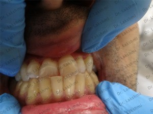 Factors that lead to Teeth Discoloration
