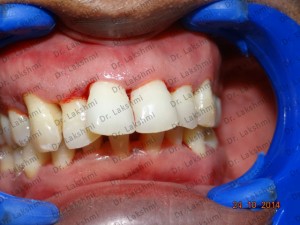 Home Teeth Whitening Kit