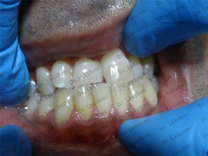 In-Office Teeth Whitening